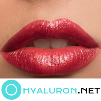 Hyaluronsäure Lippen Gesamt